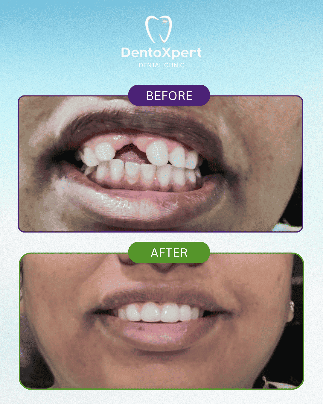 Before and after dental treatment result at DentoXpert Dental Clinic in Thane